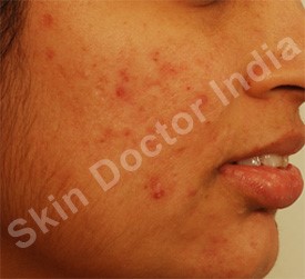 Acne Vulgaris: After medical treatment for acne followed fractional laser for the scars