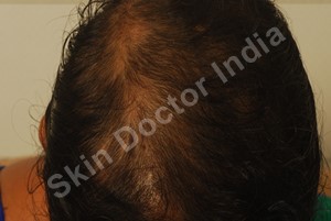 Hair loss: Before Treatment 