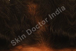 Hair Loss: After 8 sessions of QR678 hair regrowth treatment