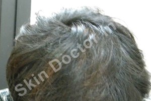 Hair Loss: After Day of 8th session of QR 678 treatment