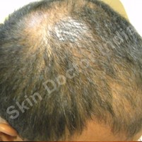 Hair Loss: Before Treatment 