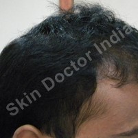 Hair Loss: Day of 8th session of QR 678 hair regrowth treatment
